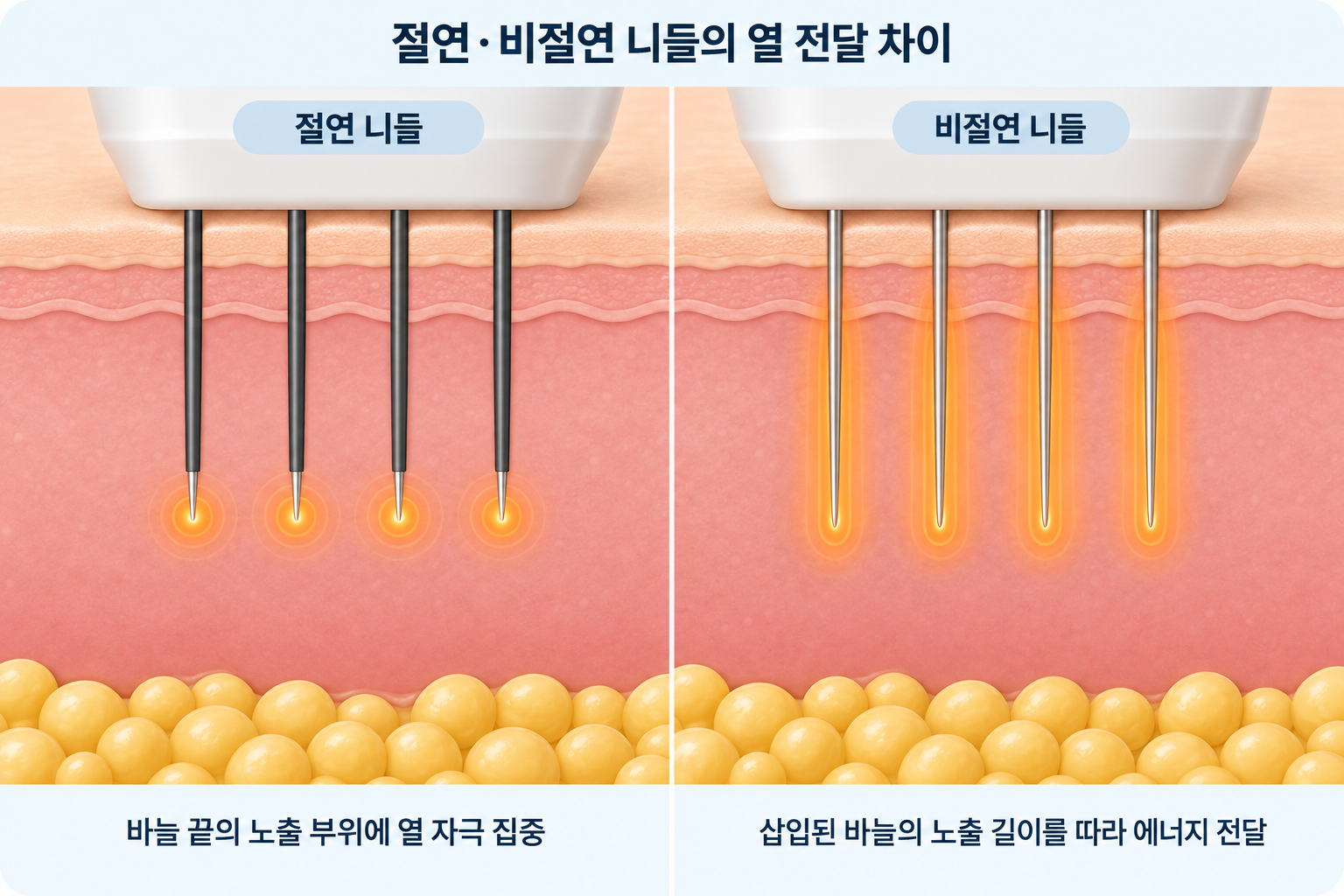 포텐자 절연 니들은 바늘 끝에 고주파 열을 집중시키고, 비절연 니들은 삽입된 바늘의 노출 부위를 따라 에너지를 전달하는 차이