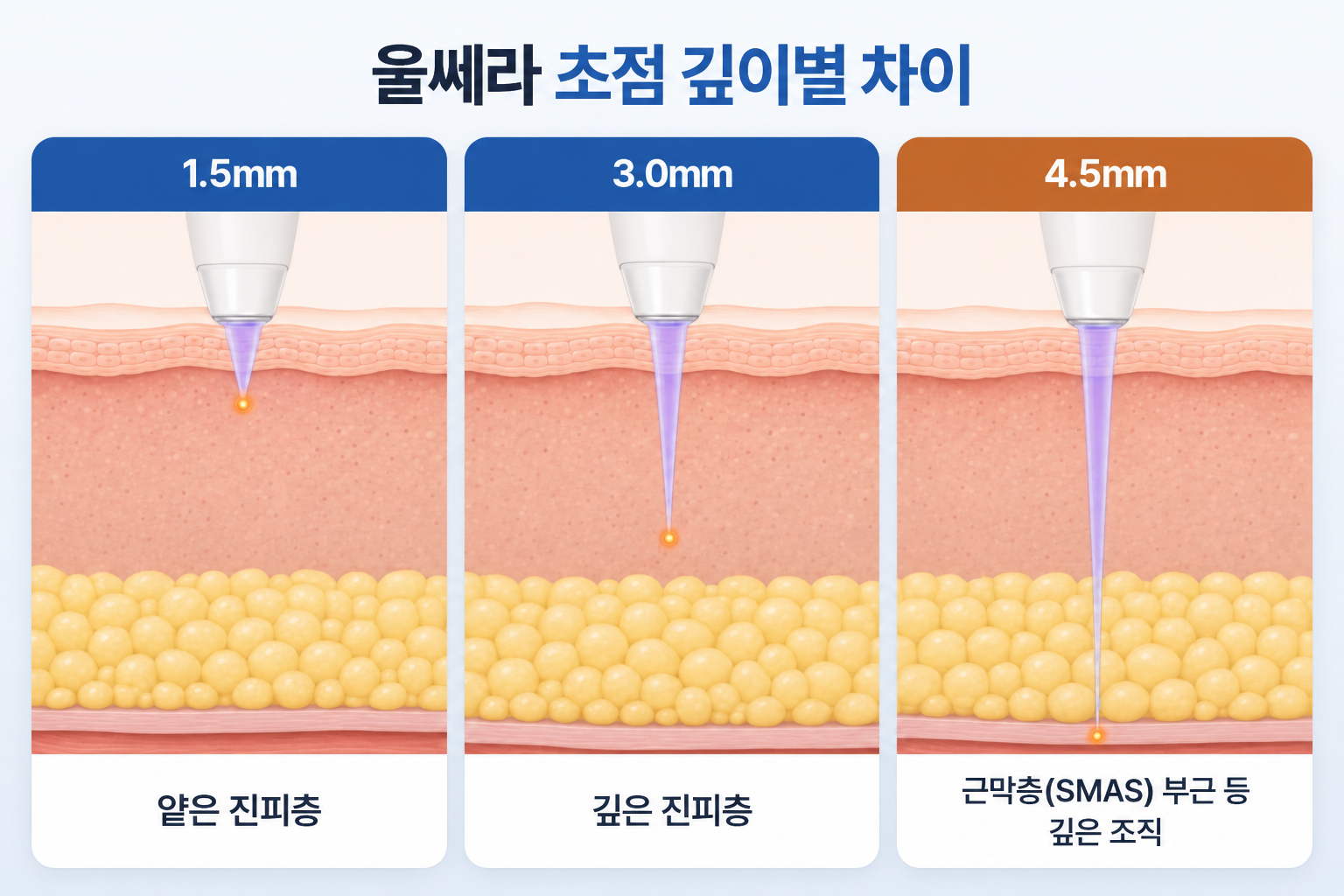 울쎄라 통증 체감에 영향을 줄 수 있는 1.5mm 얕은 진피층, 3.0mm 깊은 진피층, 4.5mm 근막층 부근의 초점 깊이 비교