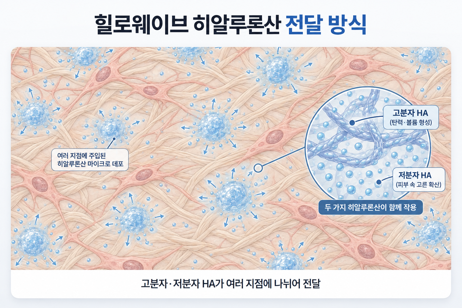 힐로웨이브 고분자·저분자 히알루론산의 피부 내 주입과 분포 방식