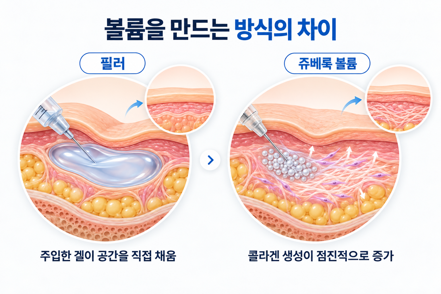 필러의 직접적인 볼륨 보완과 쥬베룩 볼륨의 콜라겐 생성 방식 비교
