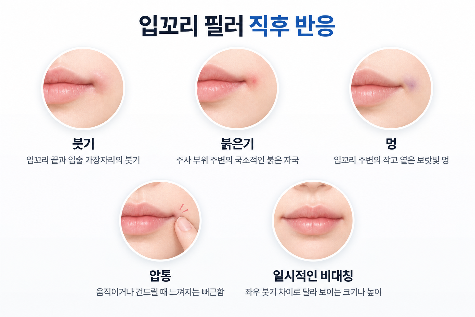 입꼬리 필러 직후 나타날 수 있는 입술 가장자리 붓기, 주사 부위 붉은기, 보랏빛 멍, 압통 및 좌우 붓기 차이에 따른 일시적 비대칭