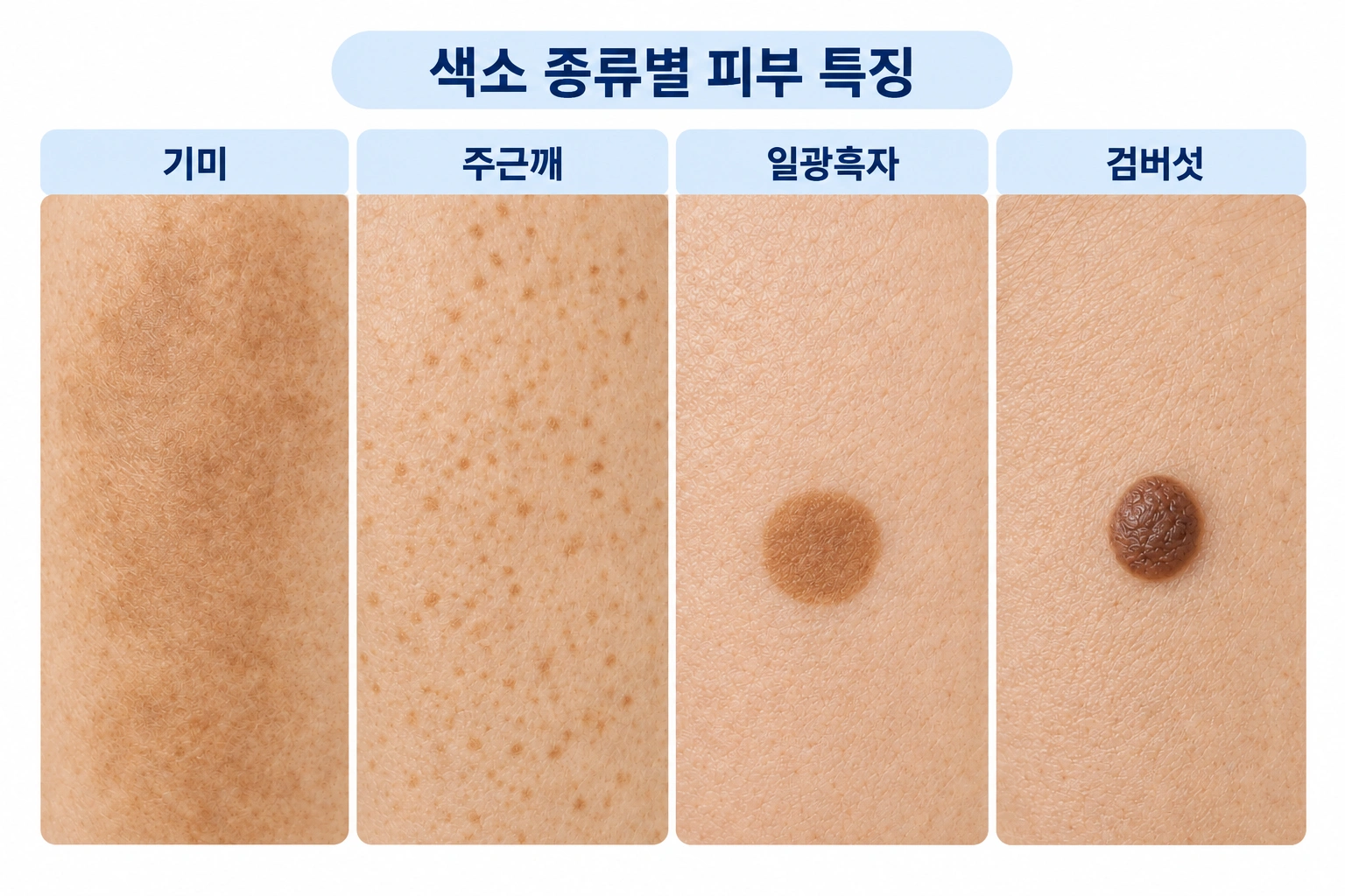 기미, 주근깨, 일광흑자, 검버섯의 피부 색소 특징을 비교한 이미지