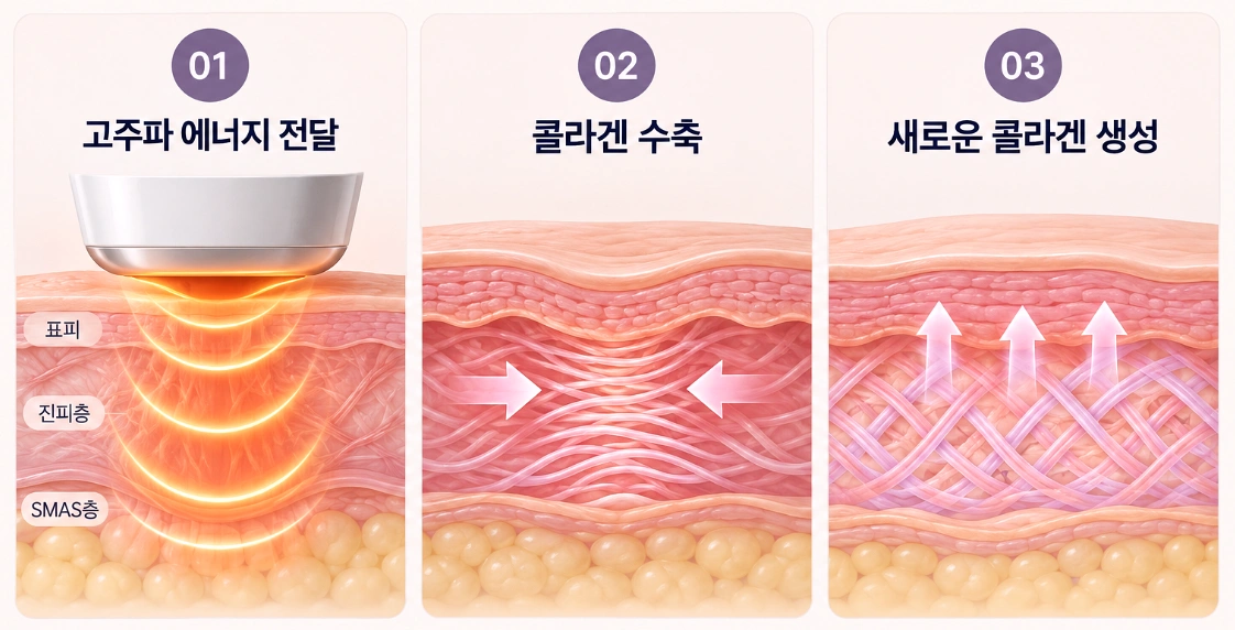 올타이트 고주파 에너지 전달부터 콜라겐 수축과 새로운 콜라겐 생성까지 3단계 원리를 나타낸 피부 단면도