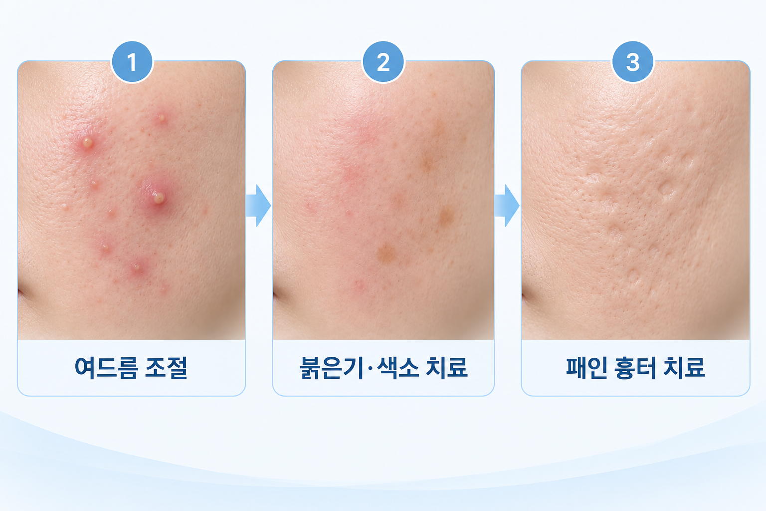 여드름 조절부터 붉은기 색소 치료와 패인 흉터 치료까지 진행 순서