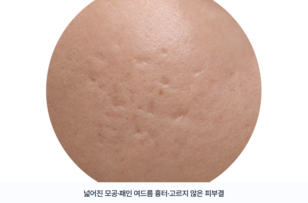 넓어진 모공과 패인 여드름 흉터, 고르지 않은 피부결을 보여주는 피부 확대 이미지