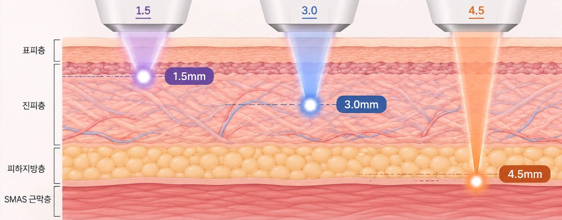 슈링크 집속초음파가 1.5mm·3.0mm·4.5mm 깊이에 전달되는 목표층을 비교한 피부 단면 모식도