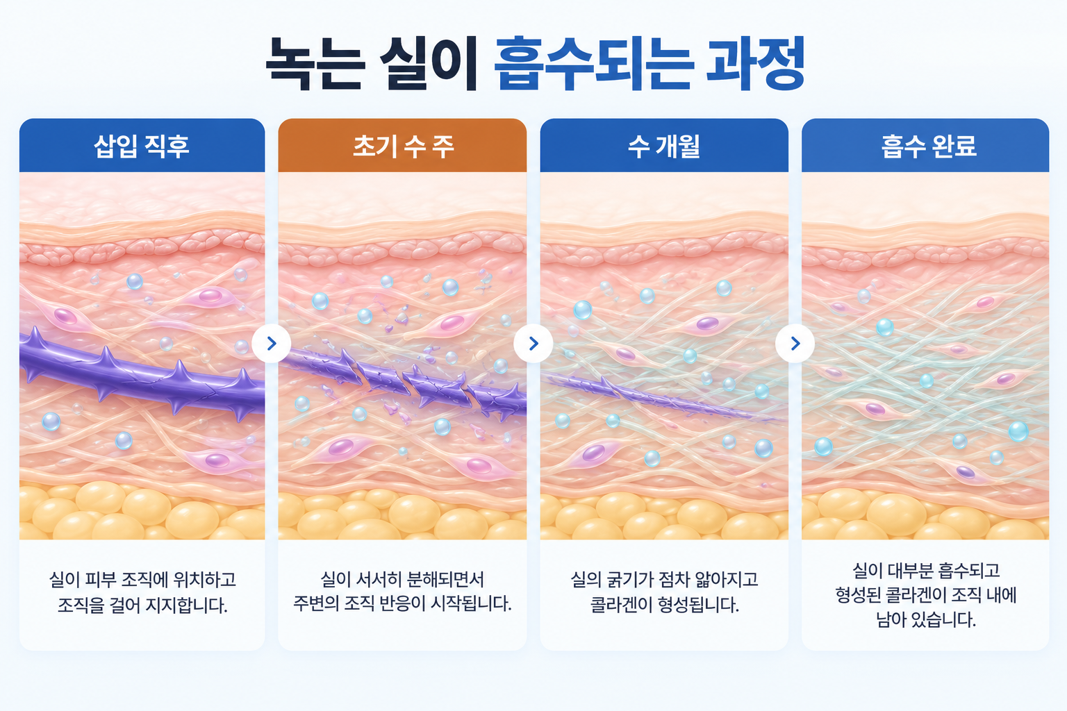 실리프팅 녹는 실이 분해되고 흡수되는 단계별 과정