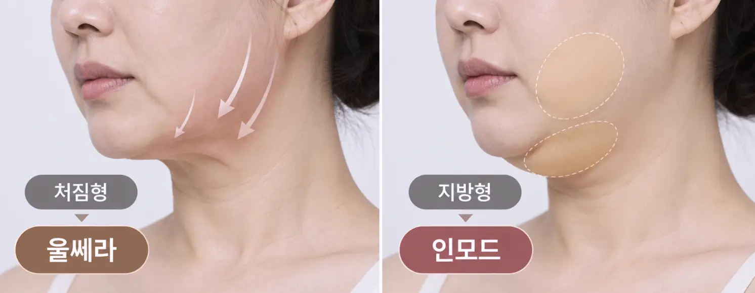 턱선 무너짐 원인에 따른 울쎄라 인모드 선택 방법