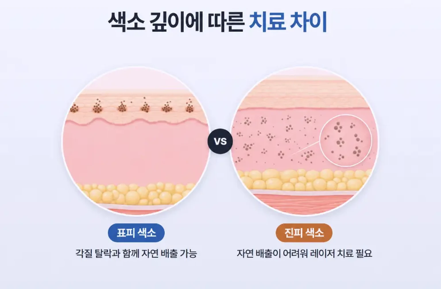 여드름 색소침착에서 표피와 진피 색소 분포를 같은 배율로 비교한 피부 단면 모식도