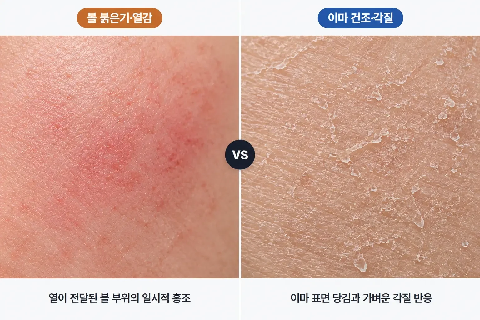골드PTT 시술 후 볼의 일시적 붉은기와 이마의 가벼운 건조 각질을 나란히 비교한 피부 확대 사진