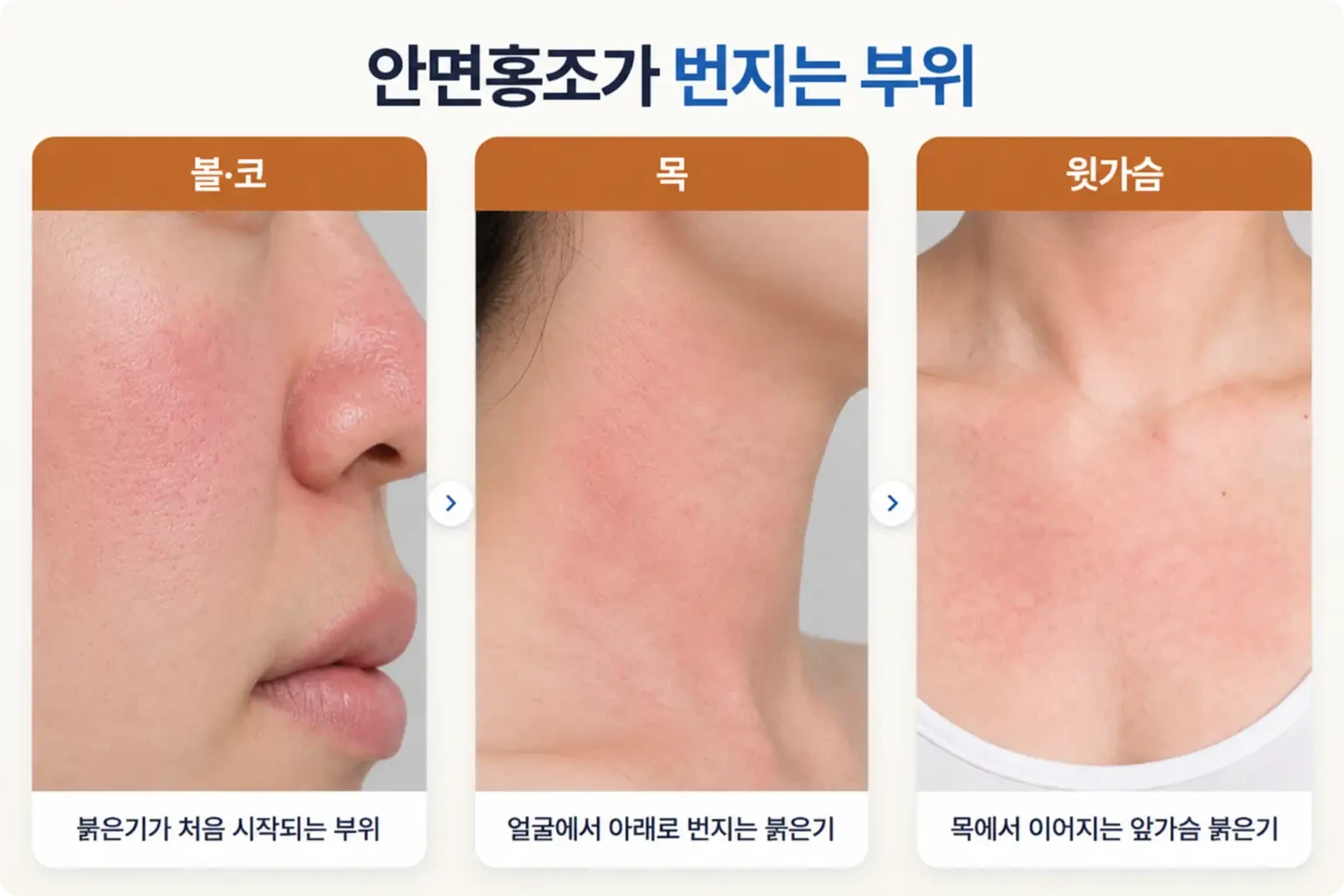 볼과 코, 목 옆선, 윗가슴 순서로 번지는 안면홍조 붉은기 분포를 부위별로 담은 비교 사진