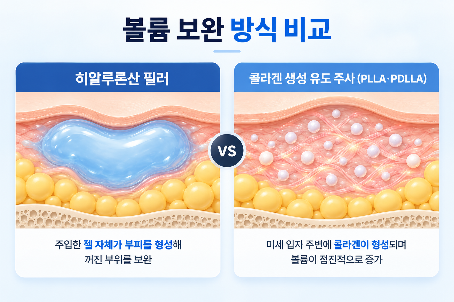 히알루론산 젤의 직접적인 볼륨 보완과 PLLA·PDLLA 미세 입자의 콜라겐 형성 차이