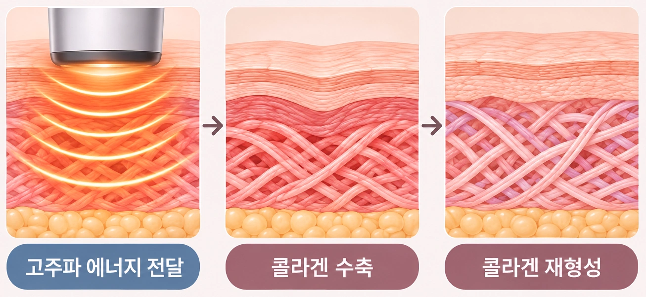 써마지 고주파 에너지 전달과 콜라겐 수축 및 재형성 과정을 나타낸 3단계 피부 단면 모식도