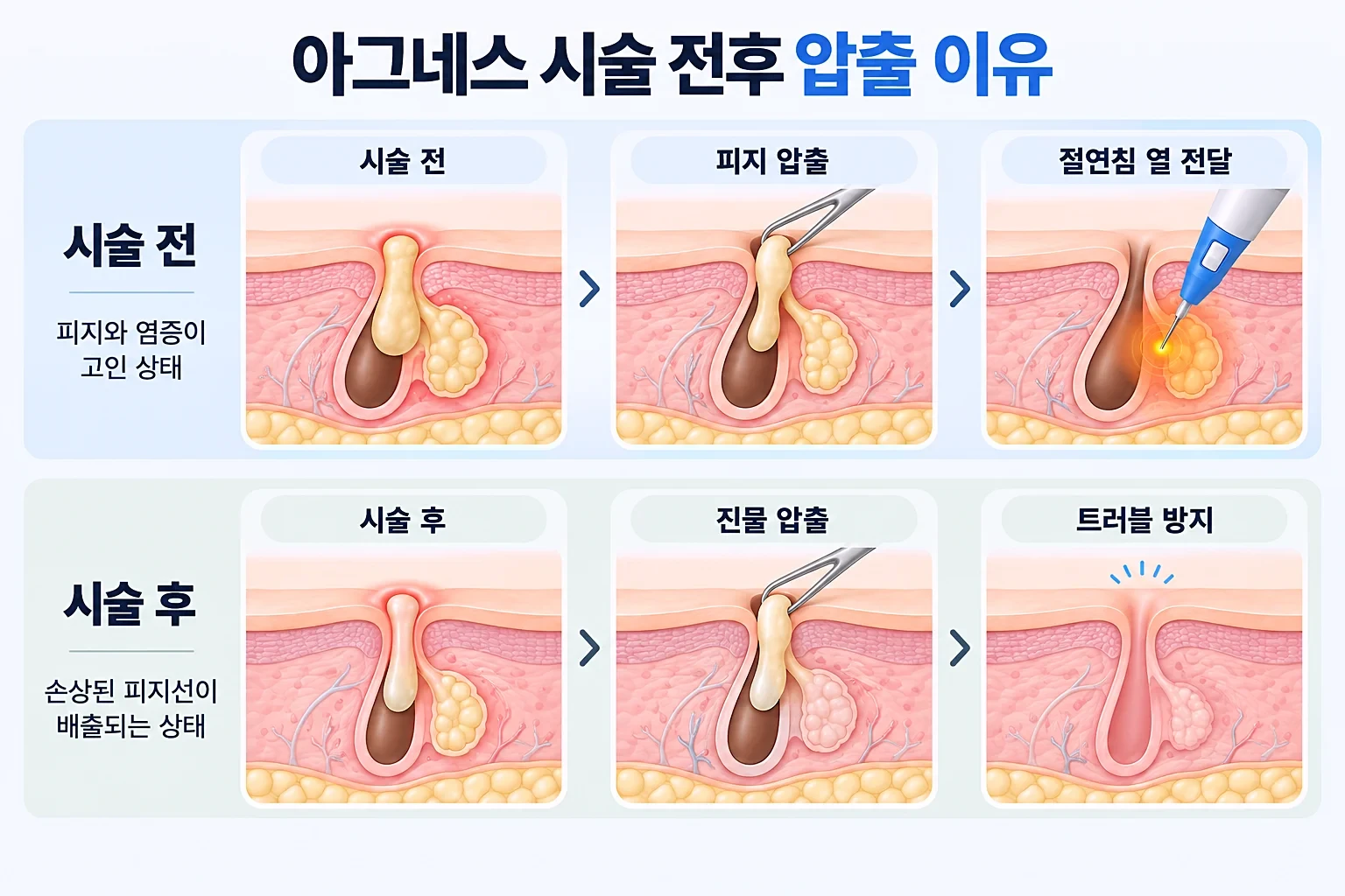 모낭에 고인 피지, 압출 후 상태, 침 끝 열 전달을 단계별로 비교한 피부 단면 모식도