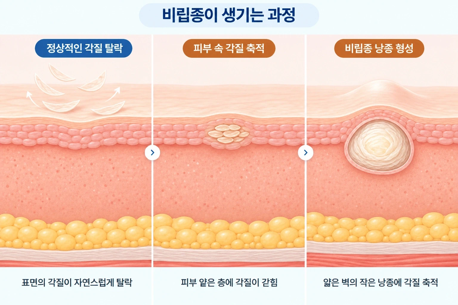 비립종 생기는 이유를 설명하는 피부 단면으로, 정상적인 각질 탈락부터 피부 얕은 층의 각질 축적과 작은 낭종 형성까지의 3단계 과정
