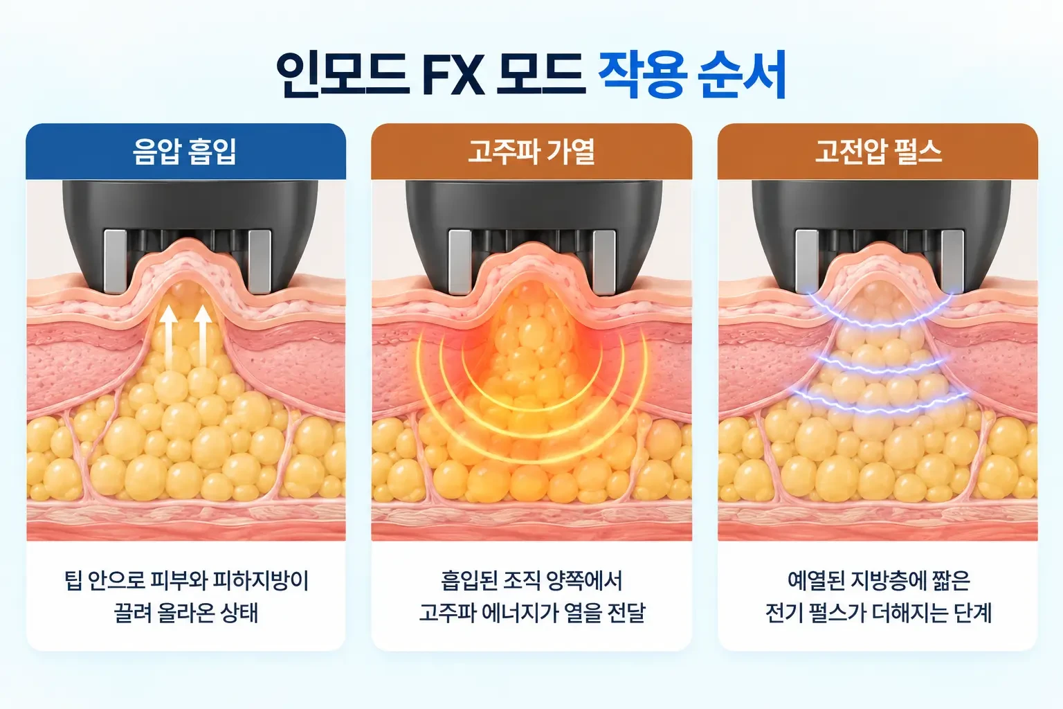 인모드 FX 팁의 음압 흡입, 고주파 가열, 고전압 펄스 전달을 단계별로 나타낸 단면 일러스트
