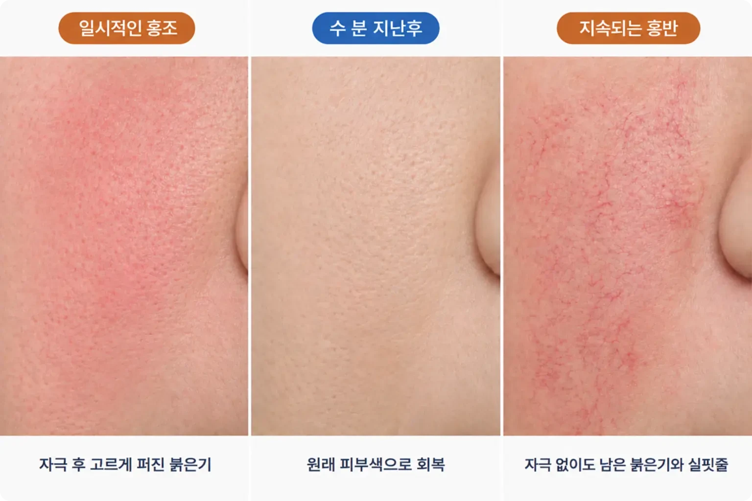 자극 직후 홍조, 가라앉은 피부색, 실핏줄이 남은 지속 홍반을 동일 배율로 나란히 놓은 비교 사진