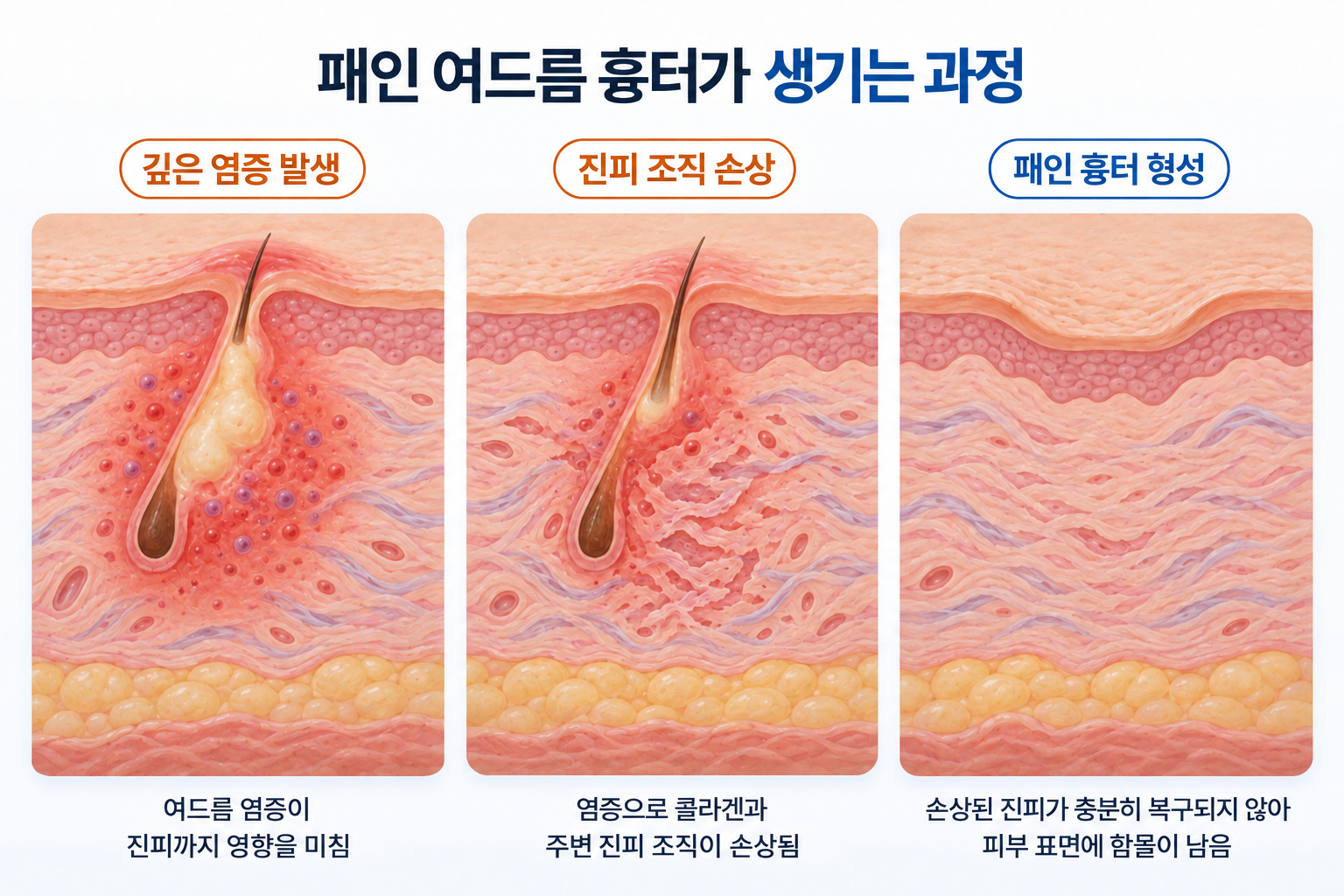 깊은 여드름 염증으로 진피의 콜라겐과 주변 조직이 손상되고 충분히 복구되지 않아 피부 표면에 패인 흉터가 남는 과정