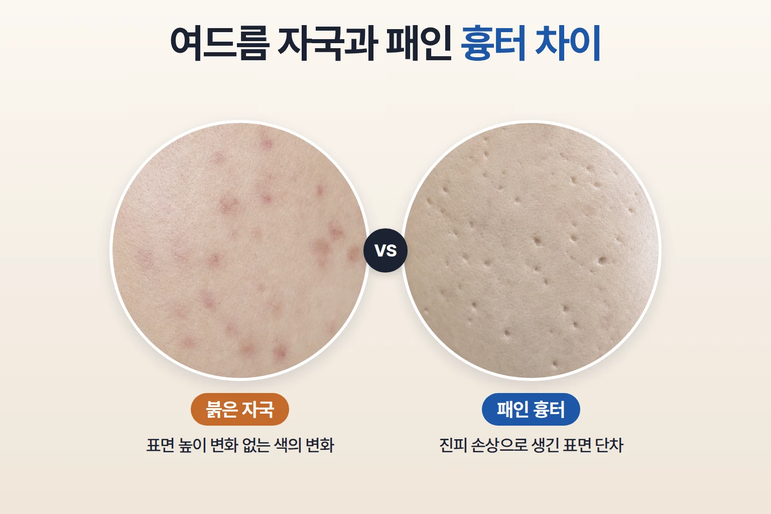 붉은 자국의 편평한 표면과 그림자가 생기는 패인 흉터를 같은 배율로 비교한 확대 사진