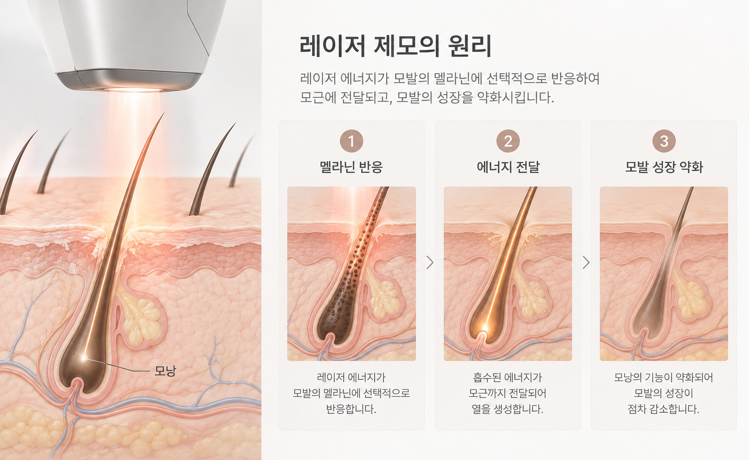 모발의 멜라닌에 레이저 에너지가 전달되어 모발 성장을 약화시키는 제모 원리