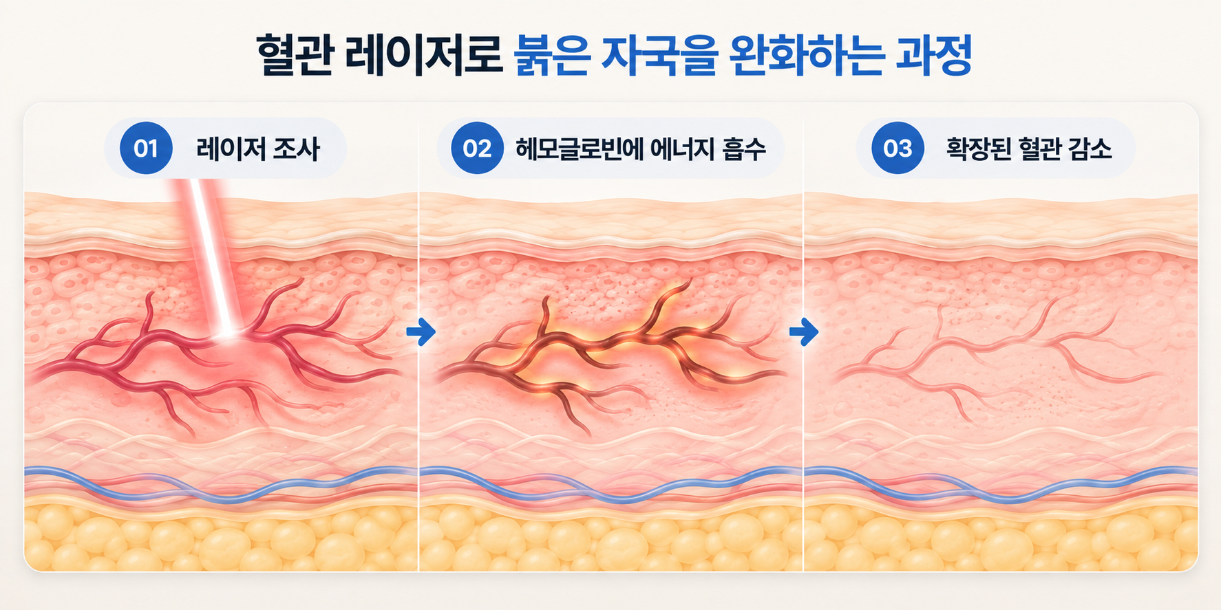 혈관 레이저 에너지가 헤모글로빈에 흡수되어 확장된 혈관을 줄이는 과정