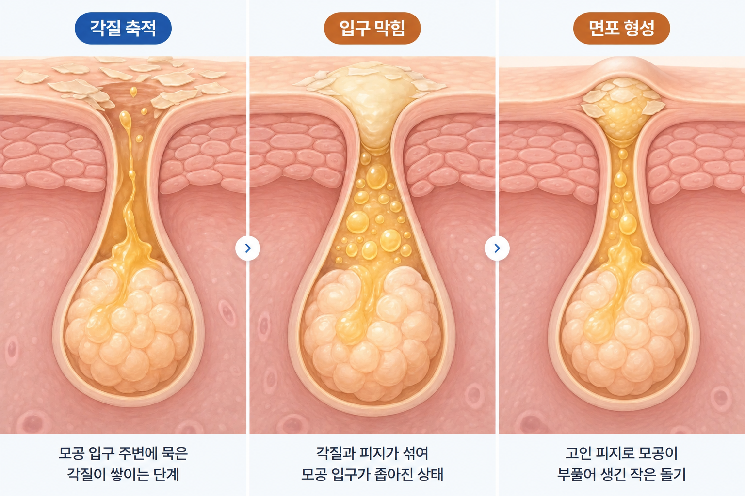 모공 입구에 각질이 축적되고 피지 배출이 막히면서 피부 표면에 작은 돌기인 폐쇄면포가 형성되는 3단계 과정