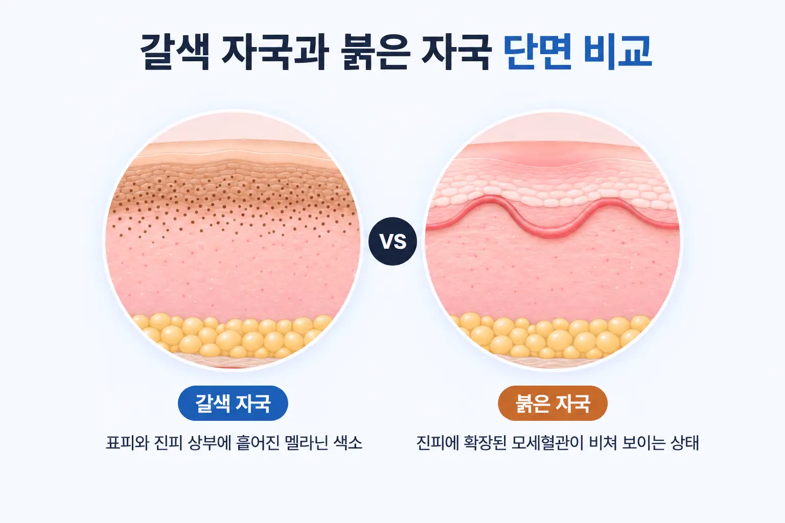 여드름 자국의 갈색 멜라닌 색소와 진피의 확장된 모세혈관을 같은 배율로 비교한 피부 단면도