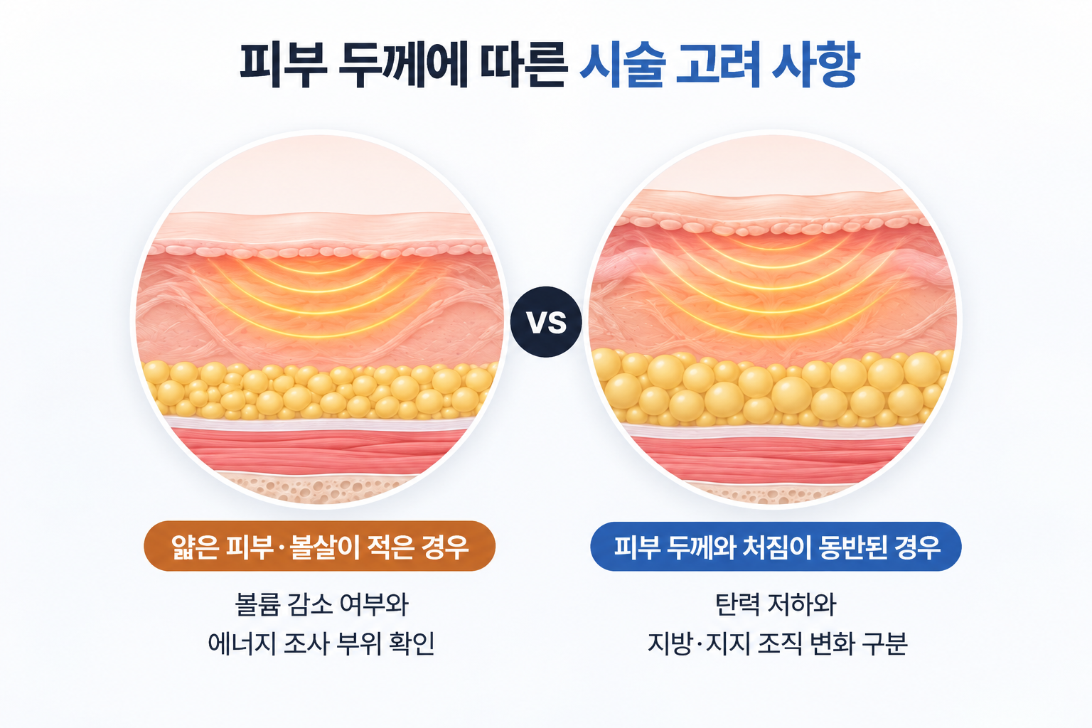 얇은 피부와 볼살이 적은 경우의 볼륨 확인 및 피부 두께와 처짐이 동반된 경우의 조직 변화 구분