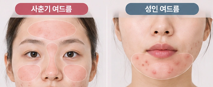 이마와 코 주변에 주로 나타나는 사춘기 여드름과 턱·입 주변에 나타나는 성인 여드름의 발생 부위 차이를 비교한 얼굴 이미지
