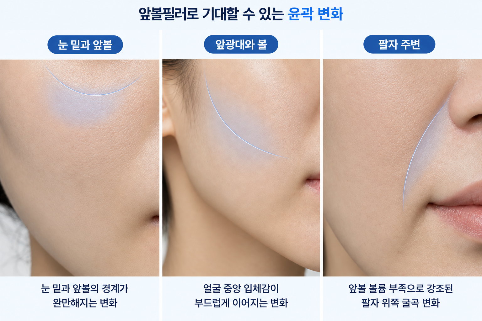 앞볼필러로 볼륨을 보완할 때 변화가 나타날 수 있는 눈 밑과 앞볼의 경계, 앞광대의 입체감, 팔자 위쪽 굴곡