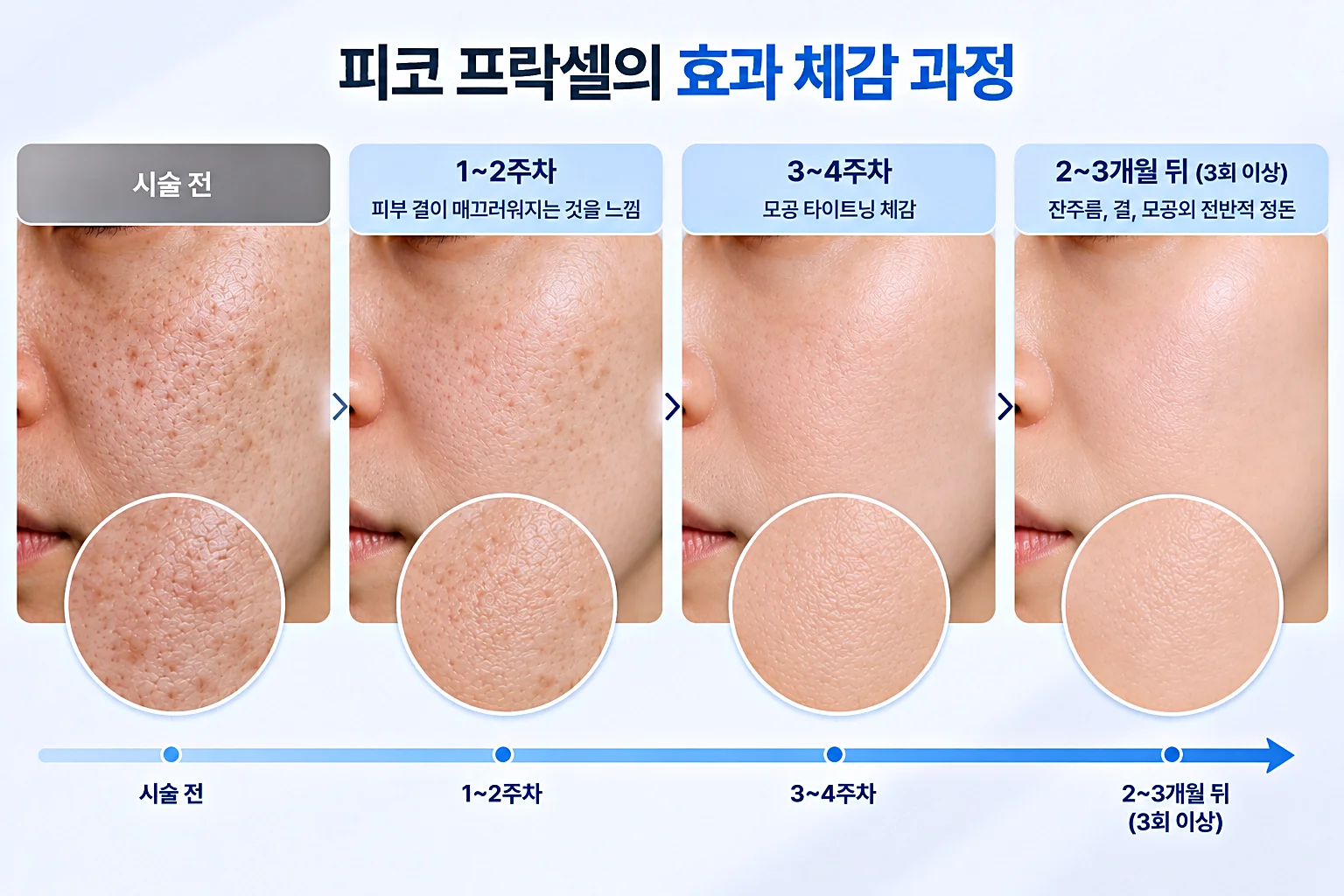 피코프락셀 효과 체감 과정 - 시술전부터 3회 이상 시술 2개월에서 3개월뒤까지