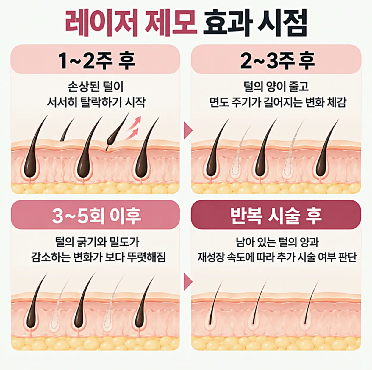 레이저 제모 후 1~2주부터 반복 시술 이후까지 털의 탈락과 굵기, 밀도 변화를 피부 단면