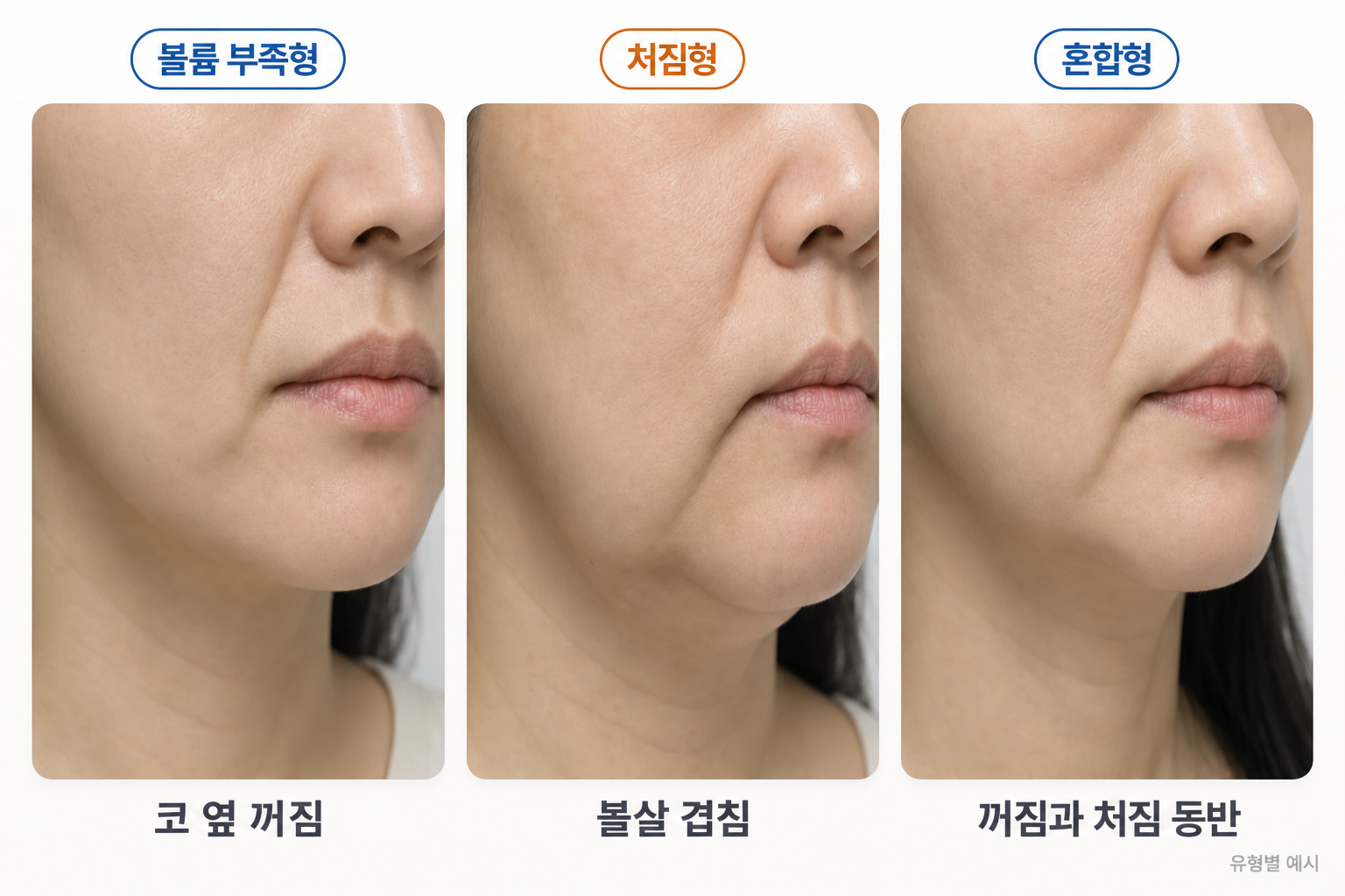 팔자주름 볼륨 부족형의 코 옆 꺼짐, 처짐형의 팔자선 위 볼살 겹침, 혼합형의 꺼짐과 처짐 동반 특징