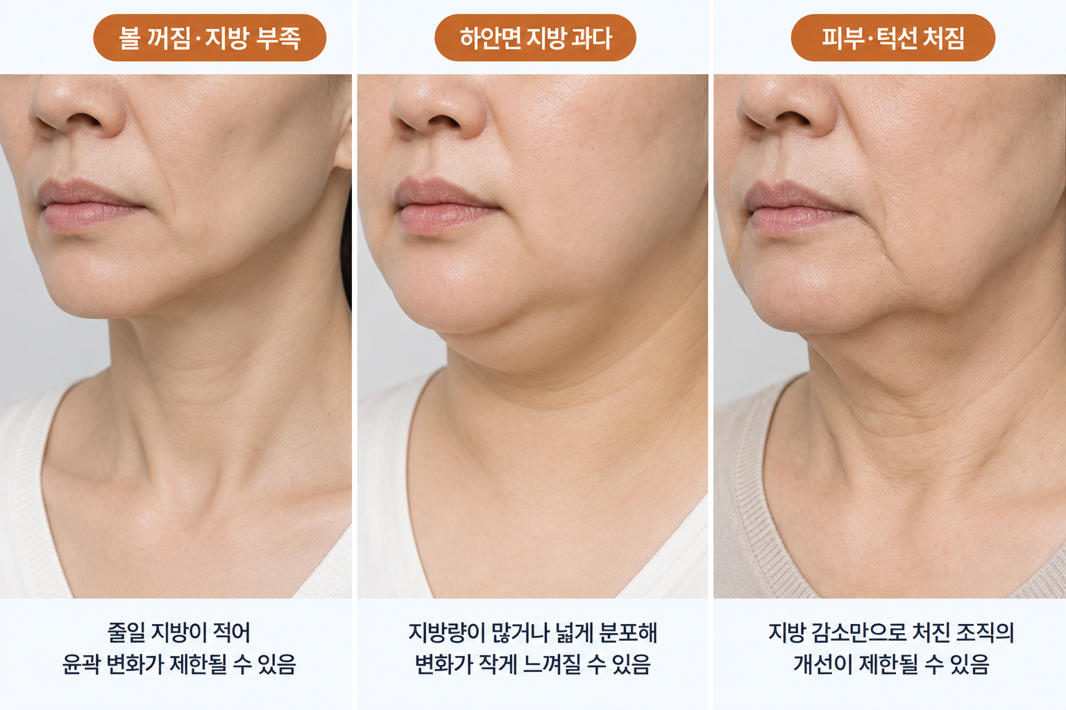 온다리프팅 효과 차이에 영향을 주는 볼 꺼짐과 지방 부족, 하안면 지방 과다, 피부와 턱선 처짐의 세 가지 얼굴 유형 비교