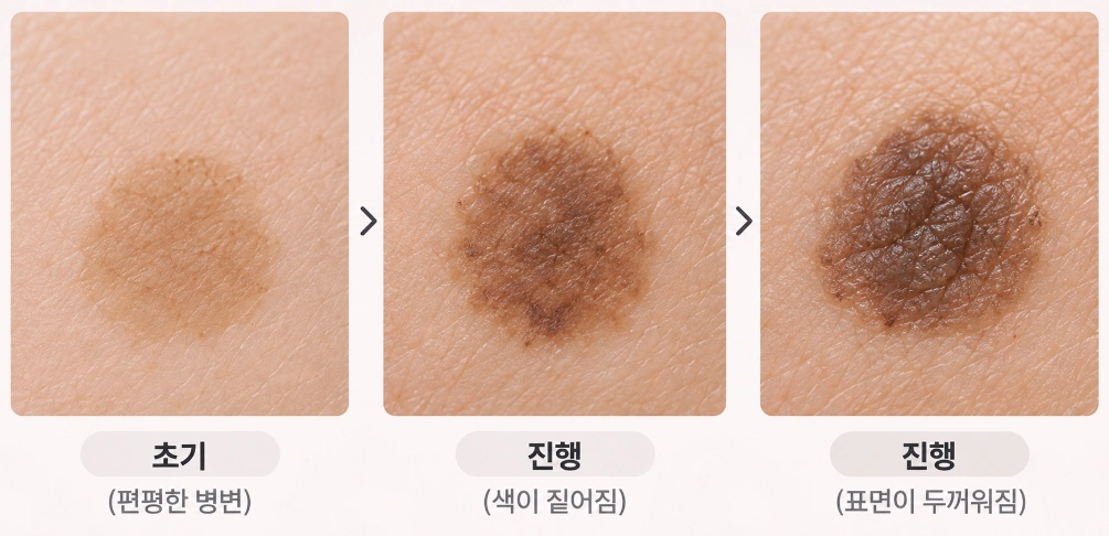 초기 편평한 검버섯이 색이 진해지고 표면이 두꺼워지는 진행 과정을 단계별로 보여주는 검버섯 변화 이미지