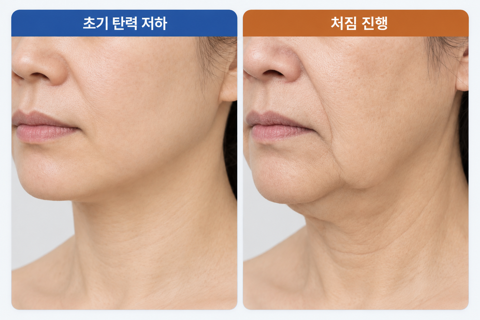 탄력-저하-처짐-비교 티타늄 리프팅 효과를 고려하는 초기 탄력 저하와 진행된 처짐 차이