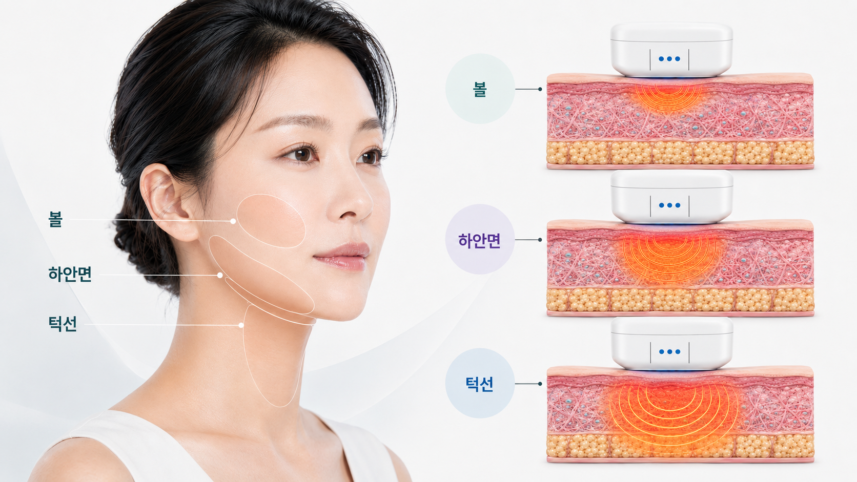 세르프 리프팅 시 볼 하안면 턱선의 피부 두께와 부위별 에너지 전달 범위를 비교한 의료 이미지
