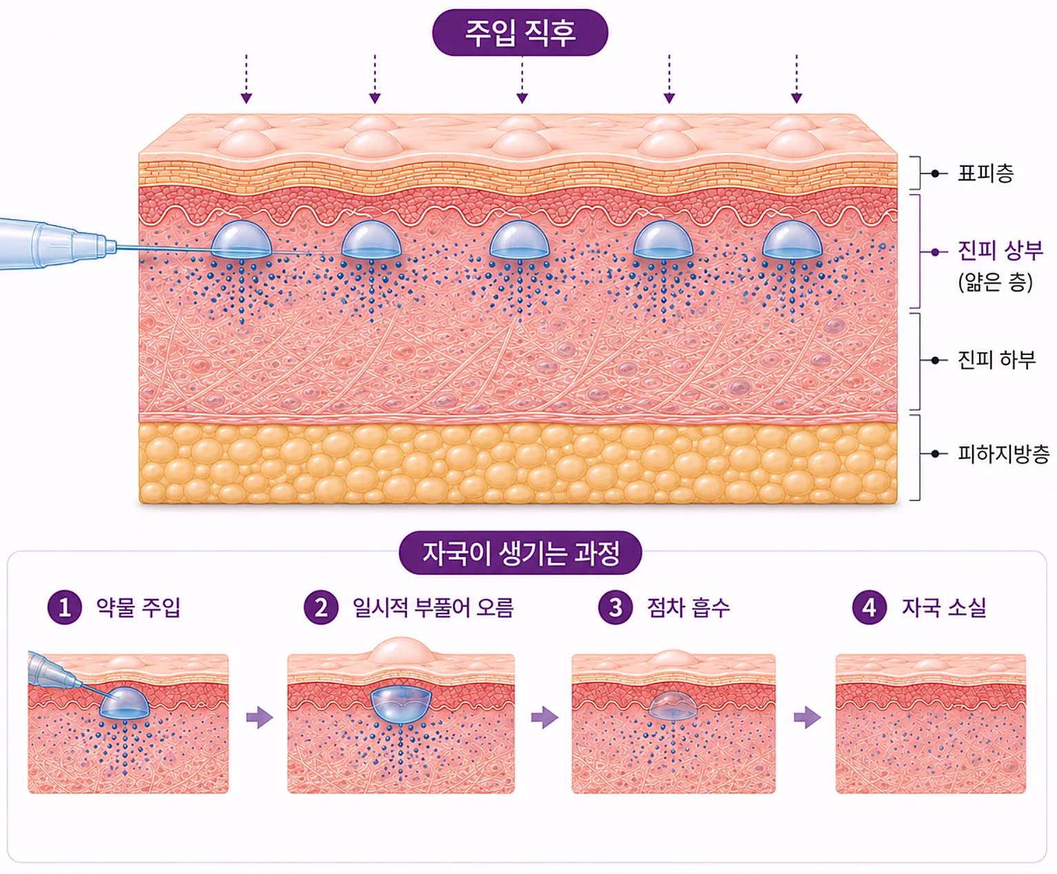 스킨보톡스 주입 방식과 직후 자국이 생기는 이유 단면도
