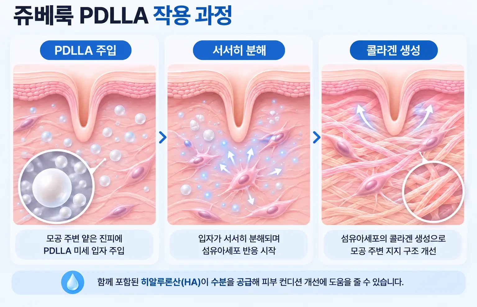 PDLLA 입자 분포, 분해, 섬유아세포의 콜라겐 생성을 단계별로 확대한 쥬베룩 작용 개념도