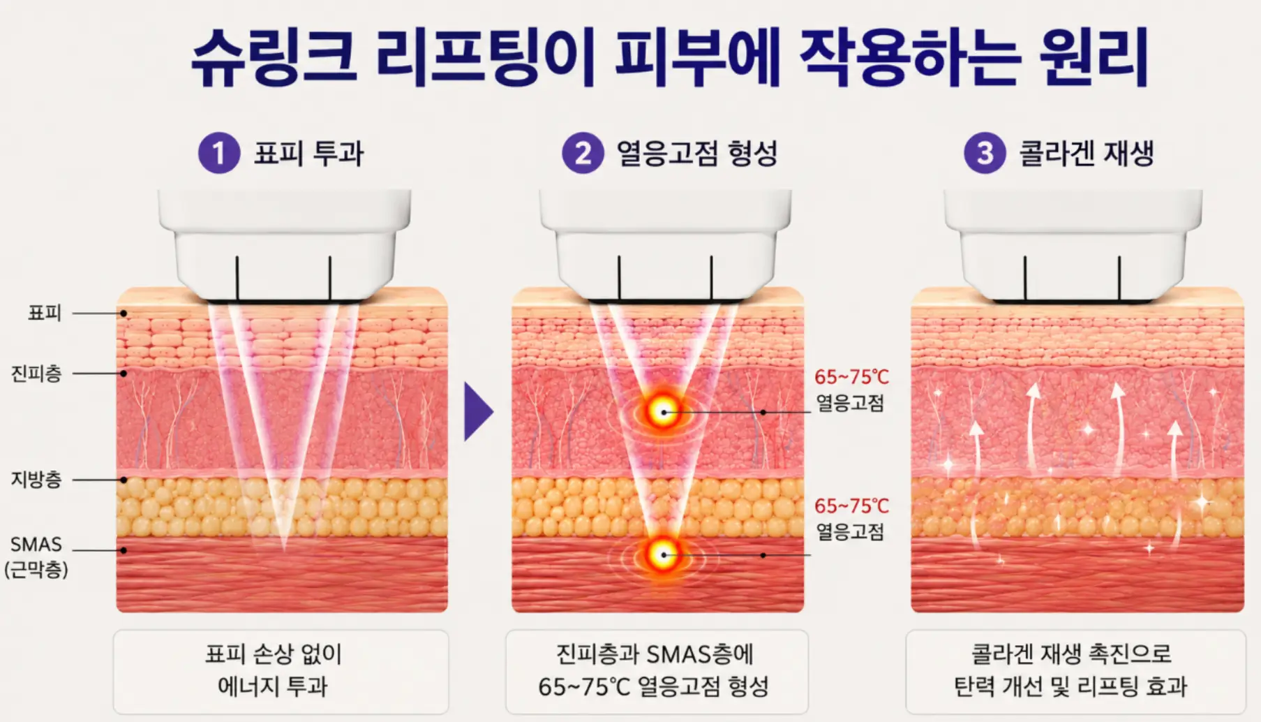 부산 슈링크 리프팅이 콜라겐을 재생시키는 시술 작용 원리 단면도