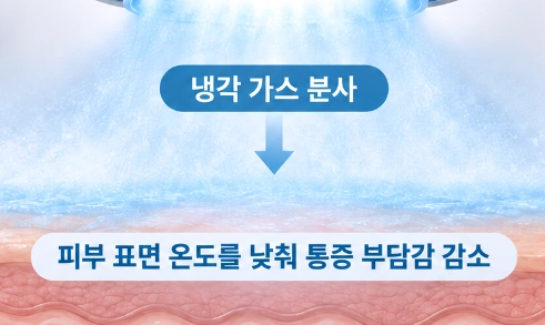 냉각 가스를 분사해 레이저 조사 시 피부 표면의 열감과 통증 부담을 줄이는 방식