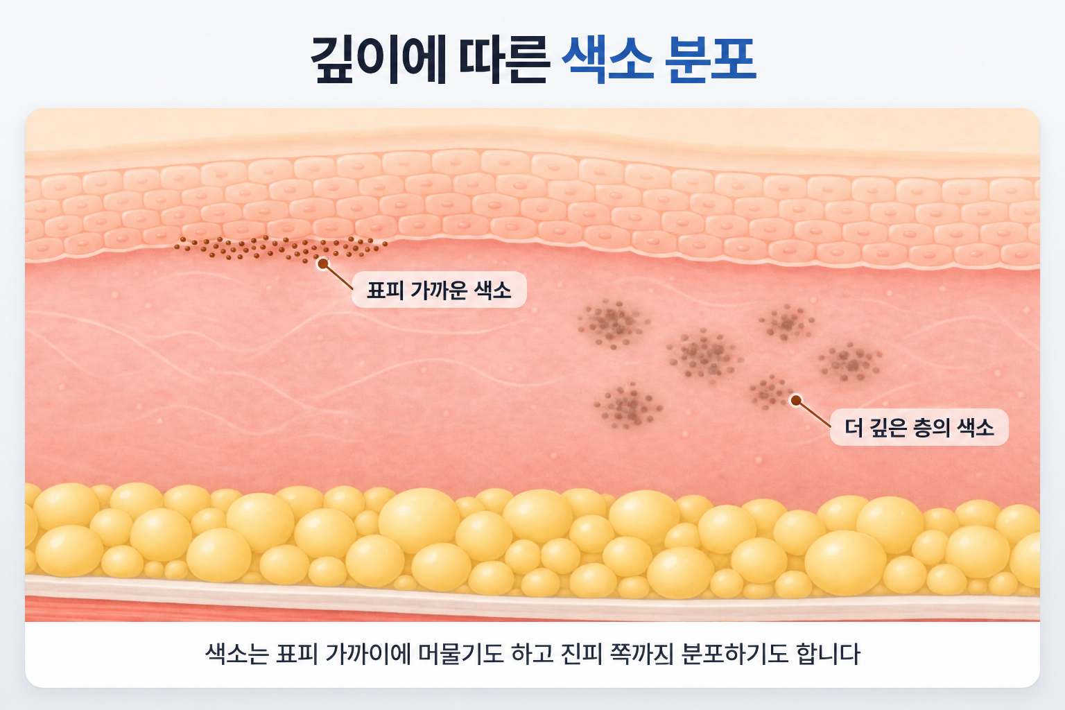 표피 가까이에 분포한 멜라닌 색소와 진피 쪽 깊은 층에 위치한 색소의 차이를 나타낸 피부 단면 구조