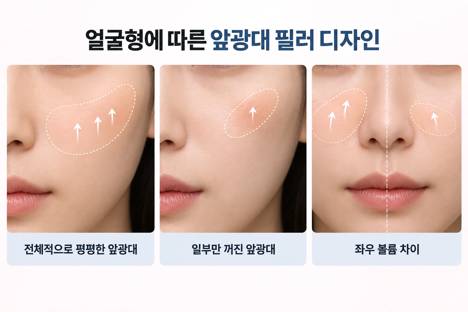 앞광대 꺼짐 범위와 좌우 볼륨 차이에 따른 필러 디자인 기준