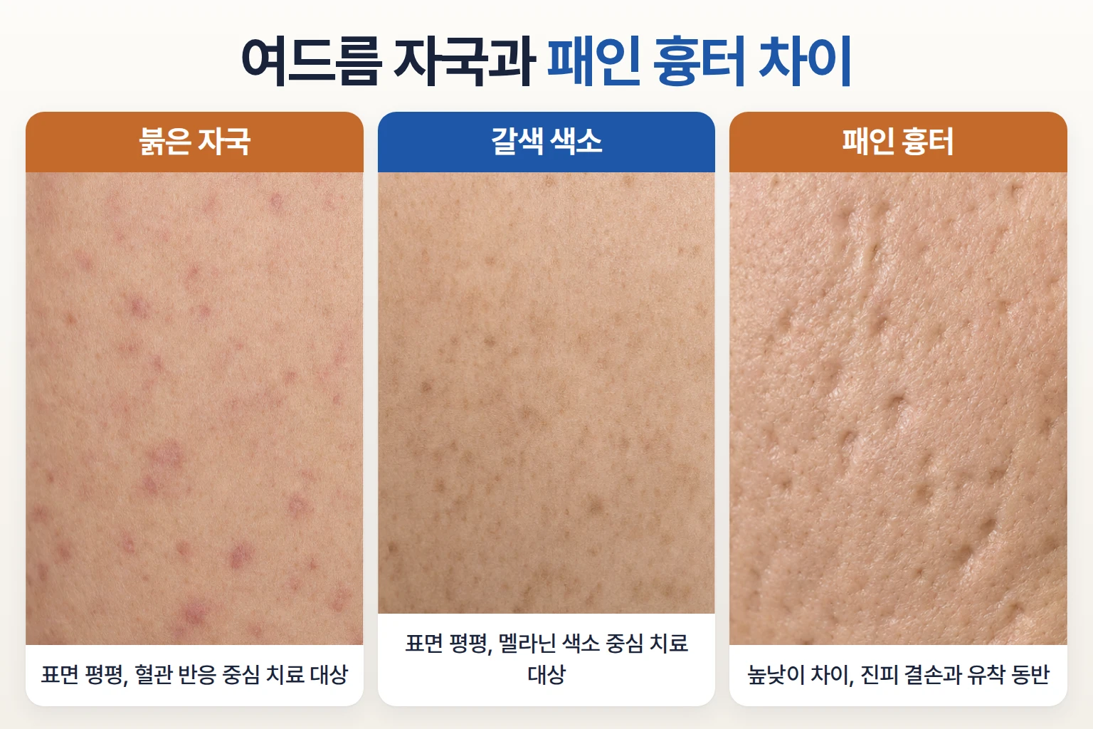 붉은 여드름 자국 갈색 색소침착 패인 흉터 표면 차이