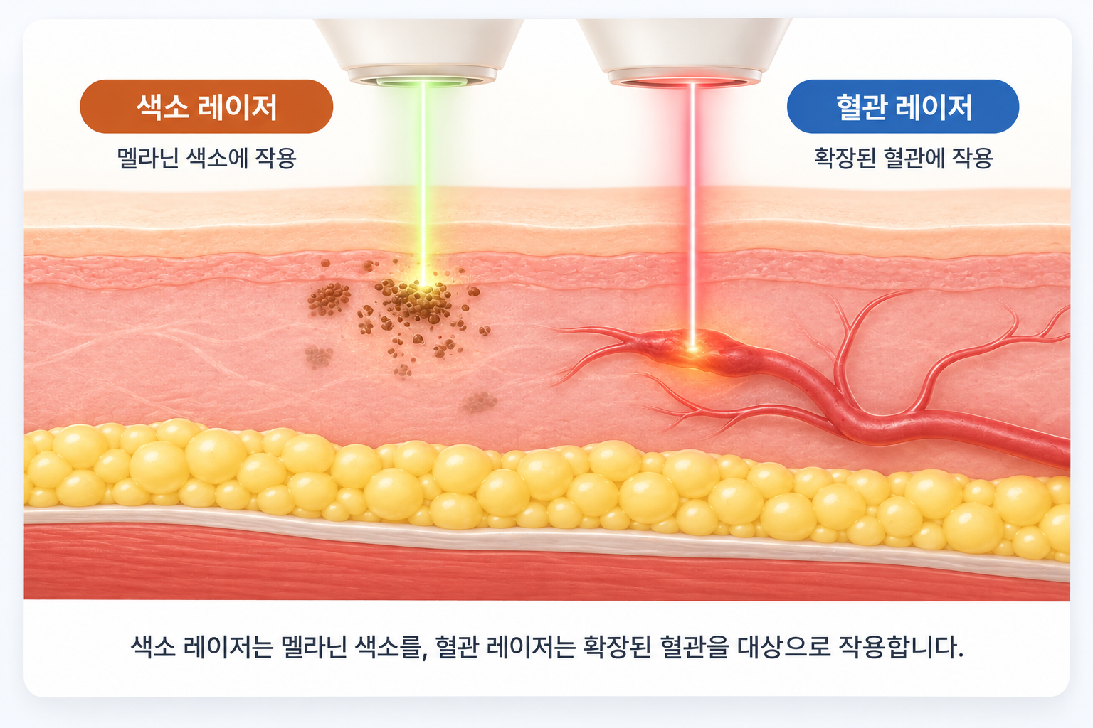 칙칙한 피부 원인별 시술에서 멜라닌 색소에 작용하는 색소 레이저와 확장된 혈관을 대상으로 하는 혈관 레이저의 작용 차이