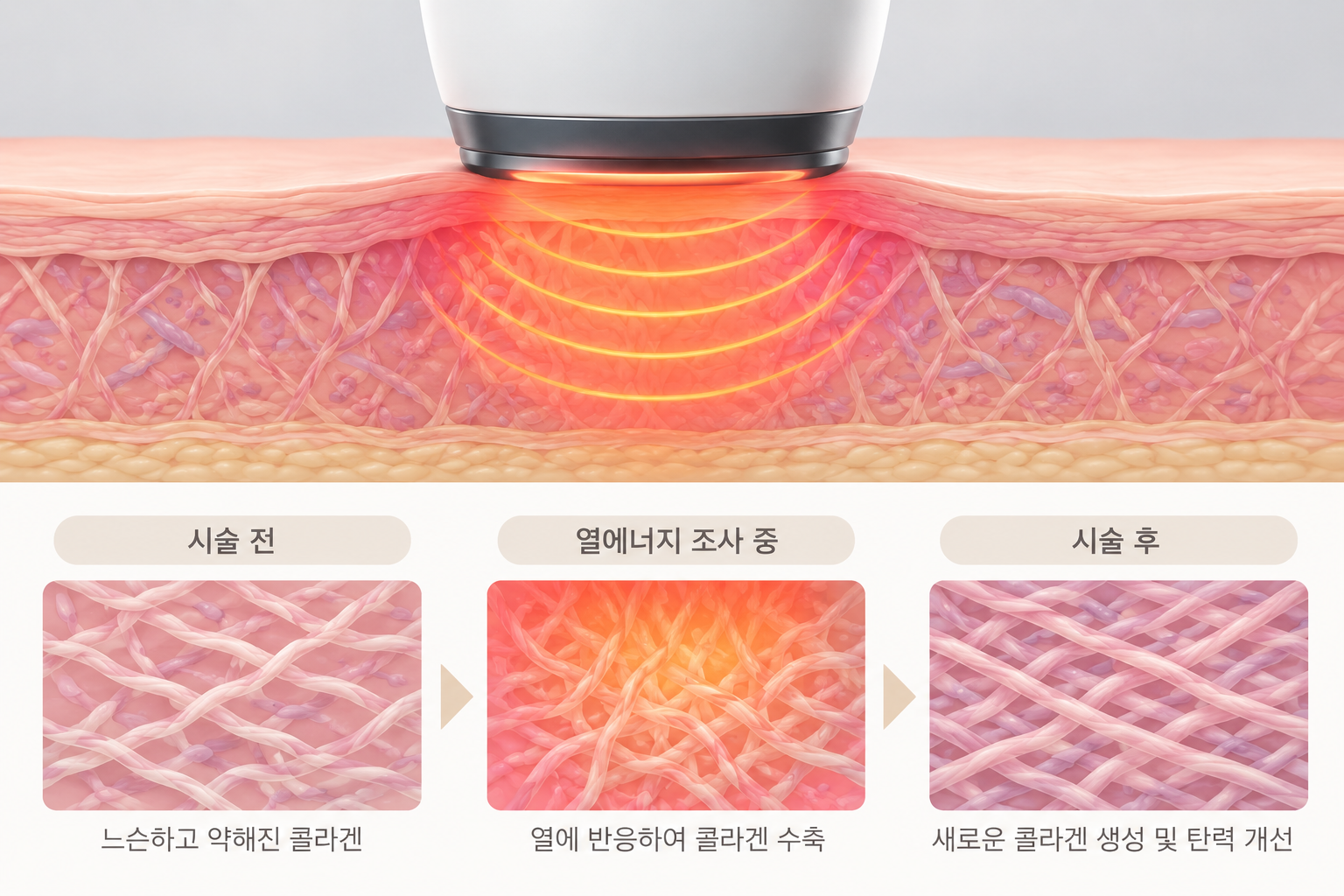 고주파 열에너지에 따른 콜라겐 수축과 새로운 콜라겐 생성 과정