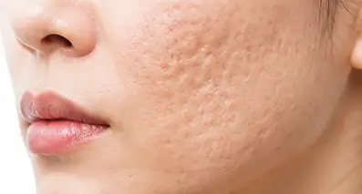 볼 주변에 나타난 피부 여드름 흉터의 모습