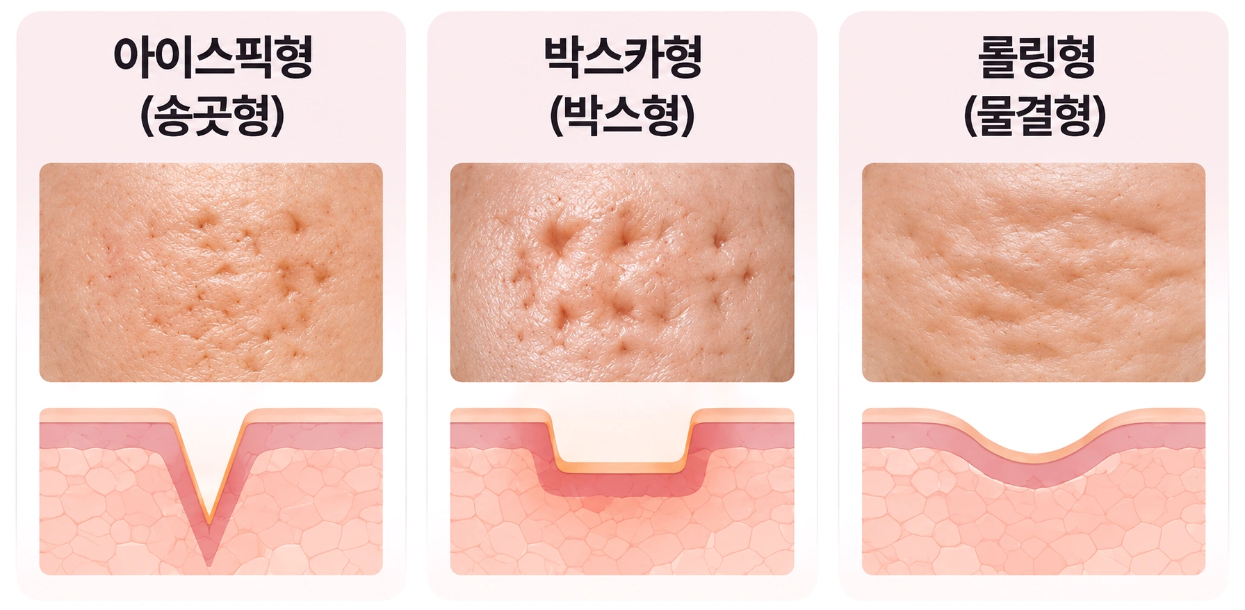 아이스픽형·박스카형·롤링형으로 구분하는 패인 흉터 유형