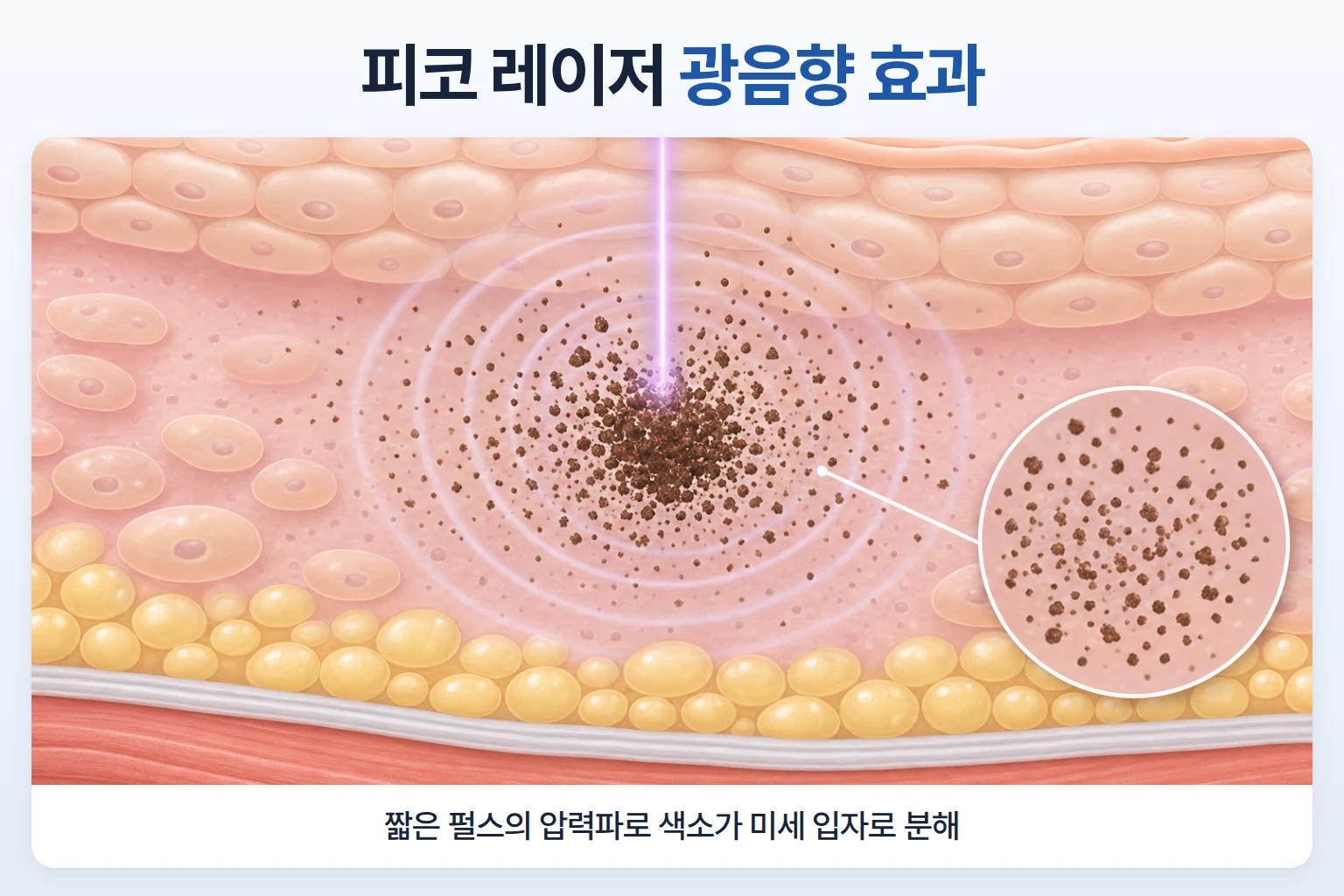 피코슈어·피코플러스 토닝의 색소 개선 원리