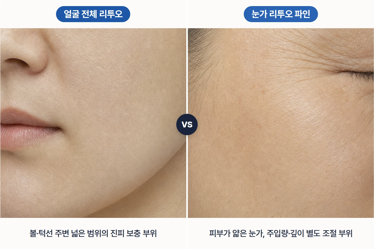 볼·턱선 주변 얼굴 전체 리투오 부위와 피부가 얇은 눈가 리투오 파인 부위를 나란히 놓은 비교 사진